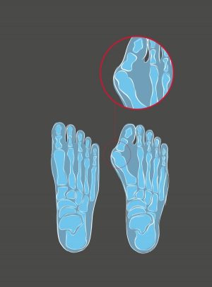 Hanwag_illu_Normal_vs_Hallux_v2_ Kopie